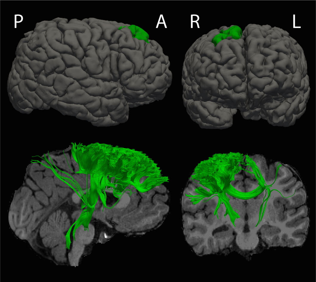 Researchers from University of Calgary used MRI to look at brain structure in young children